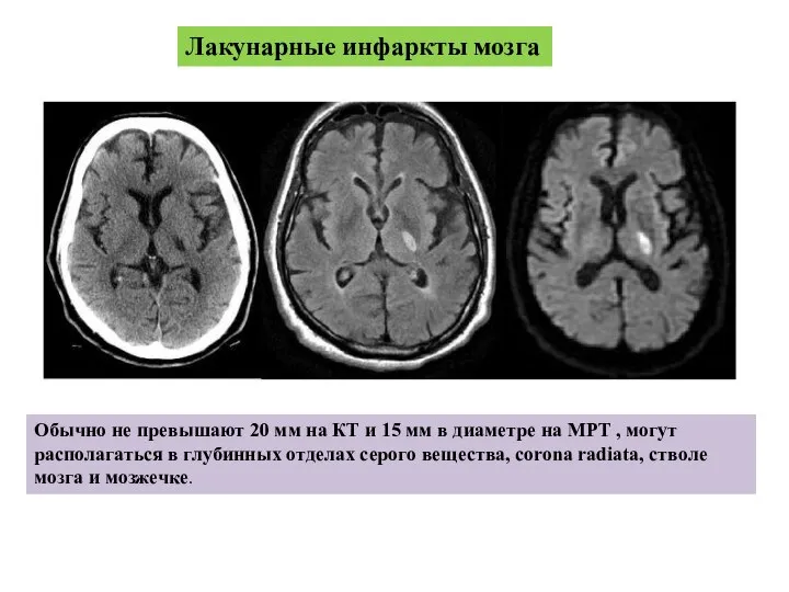 Лакунарные инфаркты мозга Обычно не превышают 20 мм на КТ и