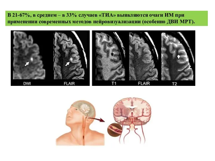 В 21-67%, в среднем – в 33% случаев «ТИА» выявляются очаги