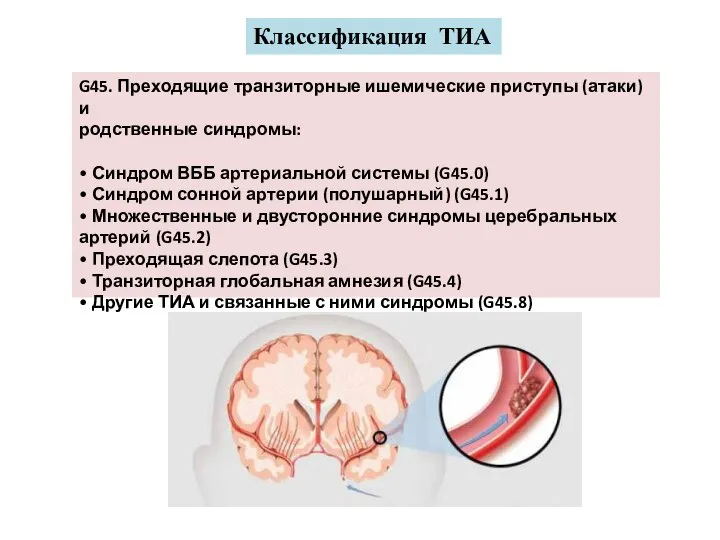 G45. Преходящие транзиторные ишемические приступы (атаки) и родственные синдромы: • Синдром