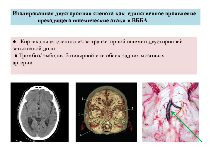 Изолированная двусторонняя слепота как единственное проявление преходящего ишемические атаки в ВББА