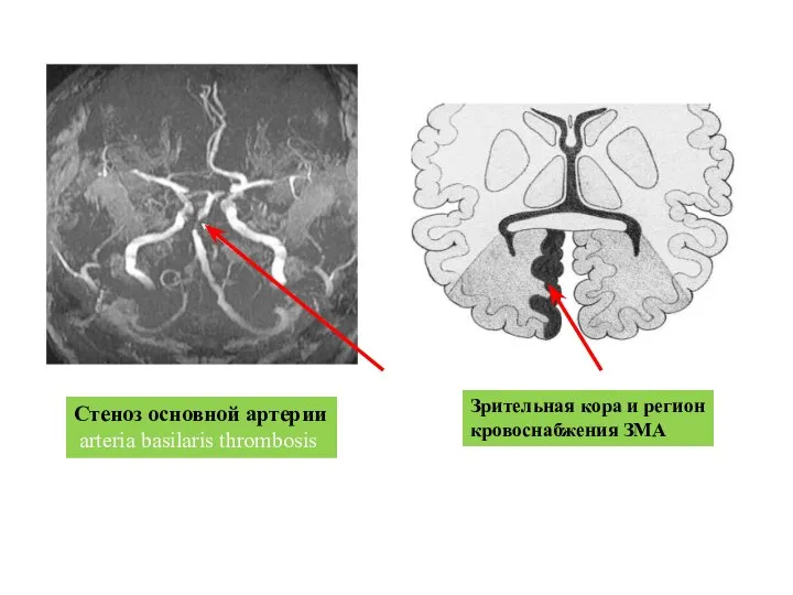 Стеноз основной артерии arteria basilaris thrombosis Зрительная кора и регион кровоснабжения ЗМА