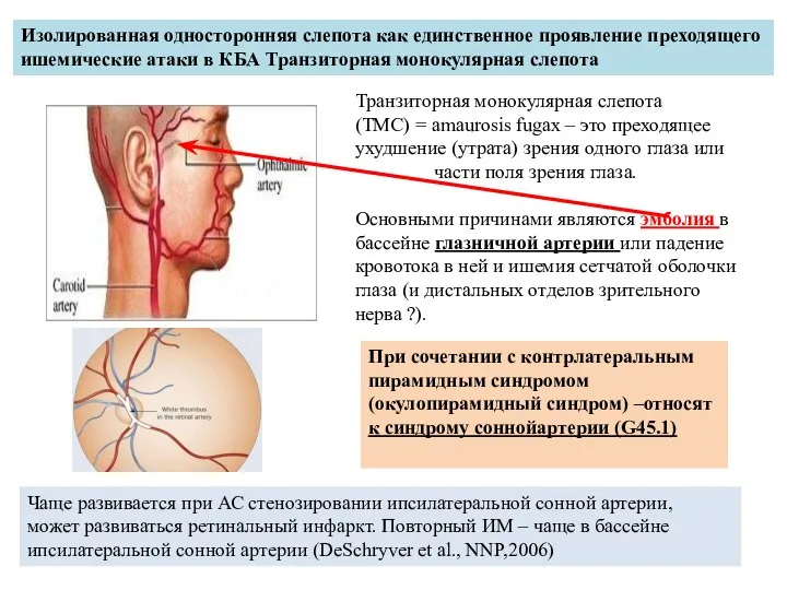 Изолированная односторонняя слепота как единственное проявление преходящего ишемические атаки в КБА