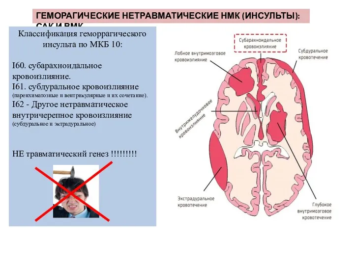 ГЕМОРАГИЧЕСКИЕ НЕТРАВМАТИЧЕСКИЕ НМК (ИНСУЛЬТЫ): САК И ВМК Классификация геморрагического инсульта по