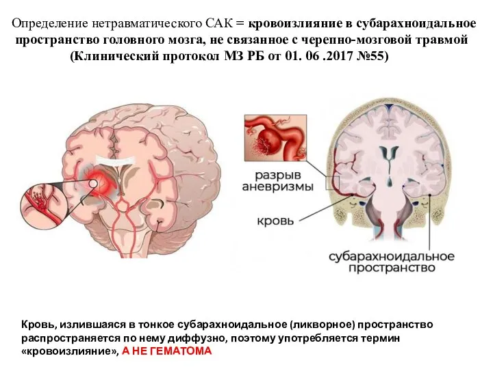 Определение нетравматического САК = кровоизлияние в субарахноидальное пространство головного мозга, не