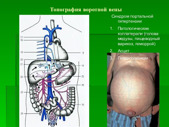 Топография воротной вены Синдром портальной гипертензии Патологические коллатерали (голова медузы, пищеводный варикоз, геморрой) Асцит Гиперспленизм