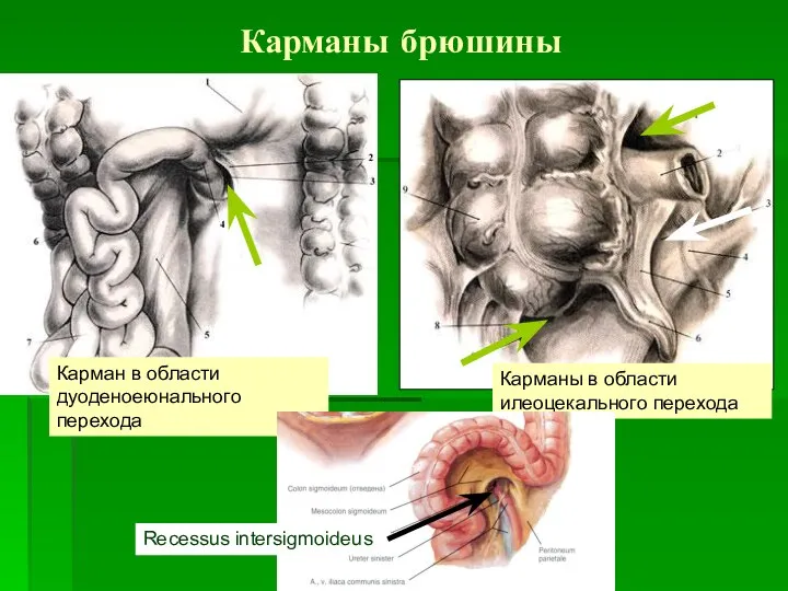 Карманы брюшины Карман в области дуоденоеюнального перехода Карманы в области илеоцекального перехода Recessus intersigmoideus