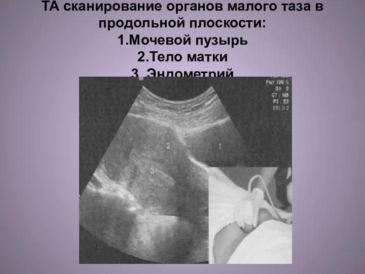 ТА сканирование органов малого таза в продольной плоскости: 1.Мочевой пузырь 2.Тело матки 3. Эндометрий