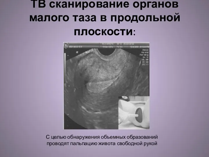 ТВ сканирование органов малого таза в продольной плоскости: С целью обнаружения