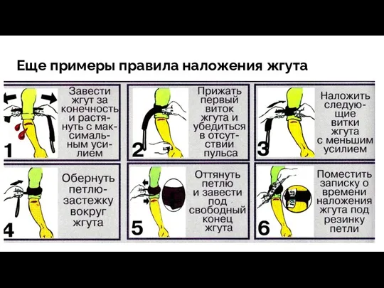 Еще примеры правила наложения жгута