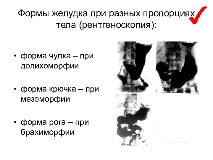 Формы желудка при разных пропорциях тела (рентгеноскопия): форма чулка – при