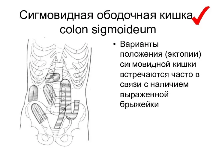 Сигмовидная ободочная кишка, colon sigmoideum Варианты положения (эктопии) сигмовидной кишки встречаются