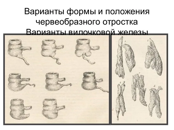 Варианты формы и положения червеобразного отростка Варианты вилочковой железы