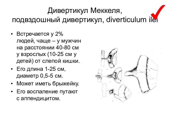 Дивертикул Меккеля, подвздошный дивертикул, diverticulum ilei Встречается у 2% людей, чаще