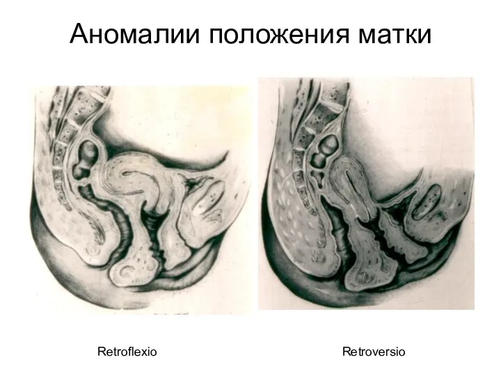 Аномалии положения матки Retroversio Retroflexio