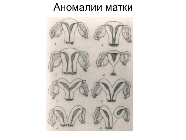 Аномалии матки