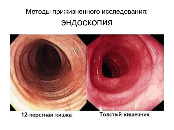 Методы прижизненного исследования: эндоскопия