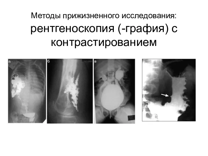 Методы прижизненного исследования: рентгеноскопия (-графия) с контрастированием