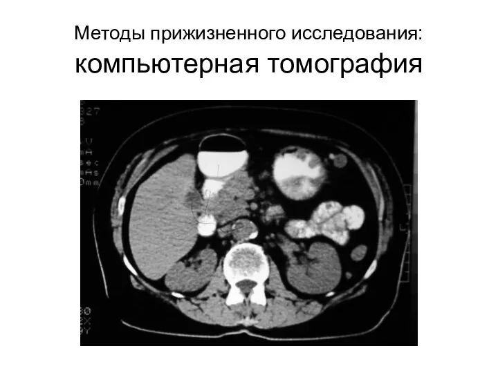 Методы прижизненного исследования: компьютерная томография