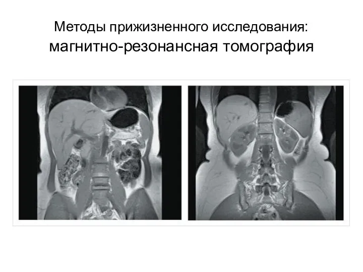 Методы прижизненного исследования: магнитно-резонансная томография