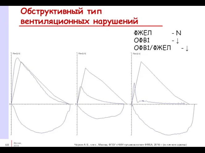 Обструктивный тип вентиляционных нарушений ФЖЕЛ - N ОФВ1 - ↓ ОФВ1/ФЖЕЛ