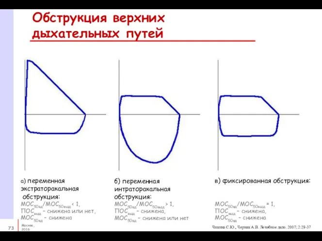 Обструкция верхних дыхательных путей б) переменная интраторакальная обструкция: МОС50вд/МОС50выд > 1,