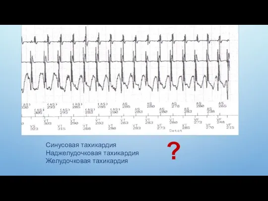 Синусовая тахикардия Наджелудочковая тахикардия Желудочковая тахикардия ?