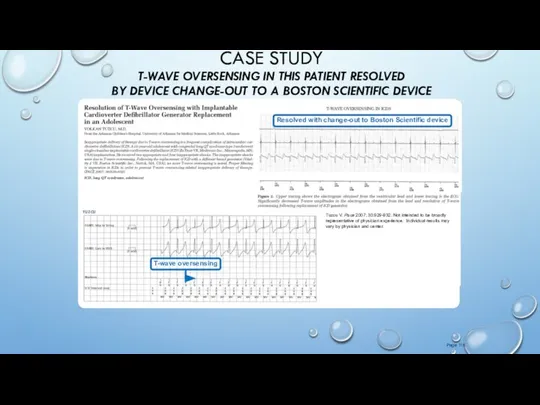 CASE STUDY T-WAVE OVERSENSING IN THIS PATIENT RESOLVED BY DEVICE CHANGE-OUT