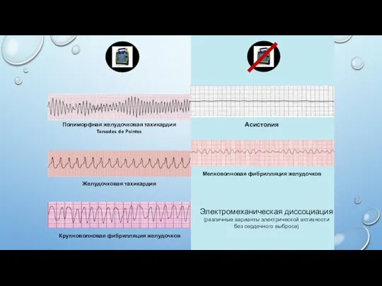Электромеханическая диссоциация (различные варианты электрической активности без сердечного выброса)