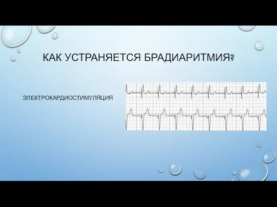 КАК УСТРАНЯЕТСЯ БРАДИАРИТМИЯ? ЭЛЕКТРОКАРДИОСТИМУЛЯЦИЯ