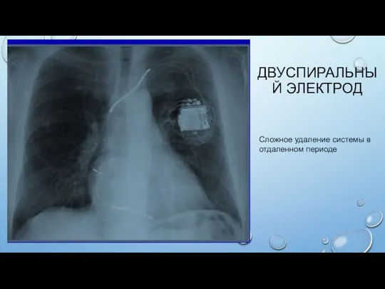 ДВУСПИРАЛЬНЫЙ ЭЛЕКТРОД Сложное удаление системы в отдаленном периоде