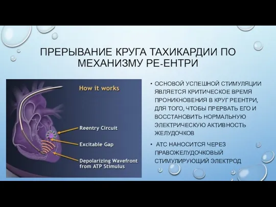 ПРЕРЫВАНИЕ КРУГА ТАХИКАРДИИ ПО МЕХАНИЗМУ РЕ-ЕНТРИ ОСНОВОЙ УСПЕШНОЙ СТИМУЛЯЦИИ ЯВЛЯЕТСЯ КРИТИЧЕСКОЕ