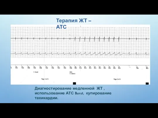 Терапия ЖТ – АТС Диагностирование медленной ЖТ , использование АТС Burst, купирование тахикардии.