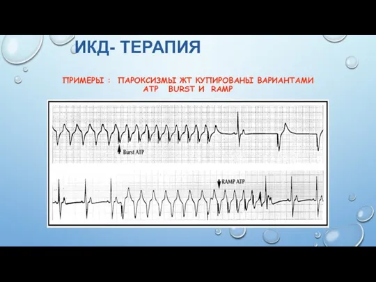 ПРИМЕРЫ : ПАРОКСИЗМЫ ЖТ КУПИРОВАНЫ ВАРИАНТАМИ ATP BURST И RAMP ИКД- ТЕРАПИЯ