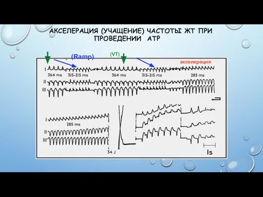 АКСЕЛЕРАЦИЯ (УЧАЩЕНИЕ) ЧАСТОТЫ ЖТ ПРИ ПРОВЕДЕНИИ ATP (Ramp) (VT) акселерация