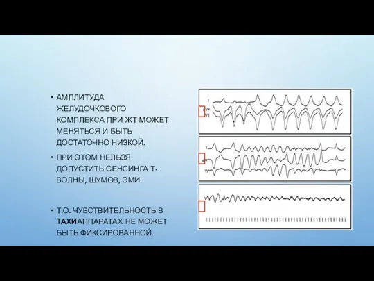 АМПЛИТУДА ЖЕЛУДОЧКОВОГО КОМПЛЕКСА ПРИ ЖТ МОЖЕТ МЕНЯТЬСЯ И БЫТЬ ДОСТАТОЧНО НИЗКОЙ.