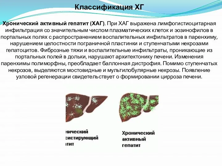 Классификация ХГ Хронический активный гепатит (ХАГ). При ХАГ выражена лимфогистиоцитарная инфильтрация