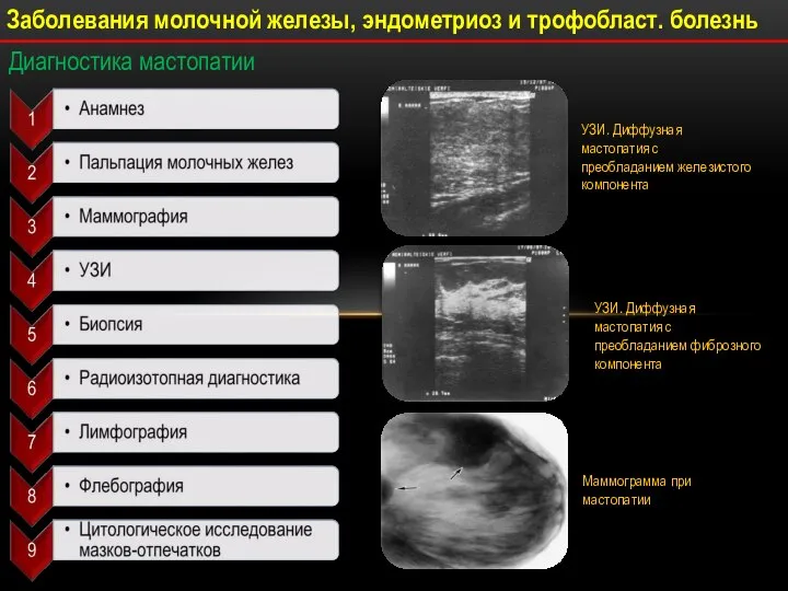 Диагностика мастопатии УЗИ. Диффузная мастопатия с преобладанием железистого компонента Маммограмма при