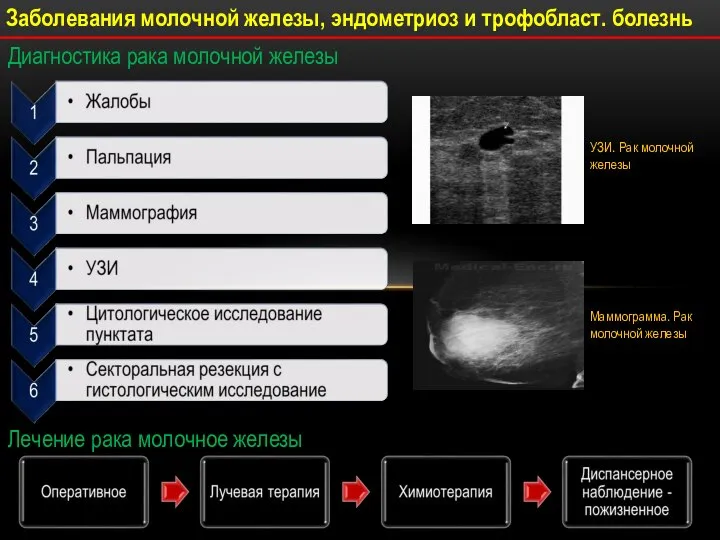 Диагностика рака молочной железы УЗИ. Рак молочной железы Маммограмма. Рак молочной