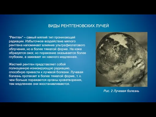 ВИДЫ РЕНТГЕНОВСКИХ ЛУЧЕЙ “Рентген” – самый мягкий тип проникающей радиации. Избыточное