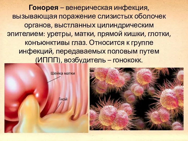 Гонорея – венерическая инфекция, вызывающая поражение слизистых оболочек органов, выстланных цилиндрическим