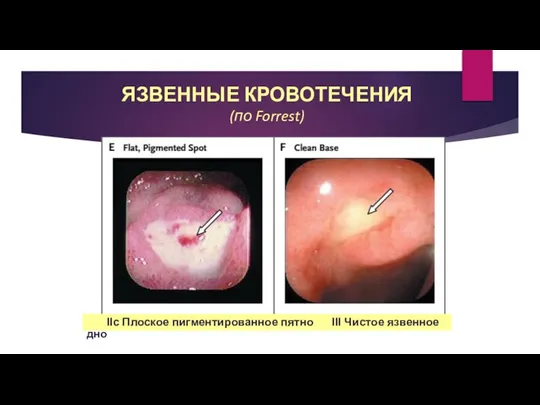 ЯЗВЕННЫЕ КРОВОТЕЧЕНИЯ (по Forrest) IIc Плоское пигментированное пятно III Чистое язвенное дно