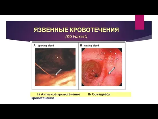 ЯЗВЕННЫЕ КРОВОТЕЧЕНИЯ (по Forrest) Ia Активное кровотечение Ib Сочащееся кровотечение