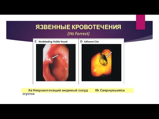 ЯЗВЕННЫЕ КРОВОТЕЧЕНИЯ (по Forrest) IIa Некровоточащий видимый сосуд IIb Свернувшийся сгусток