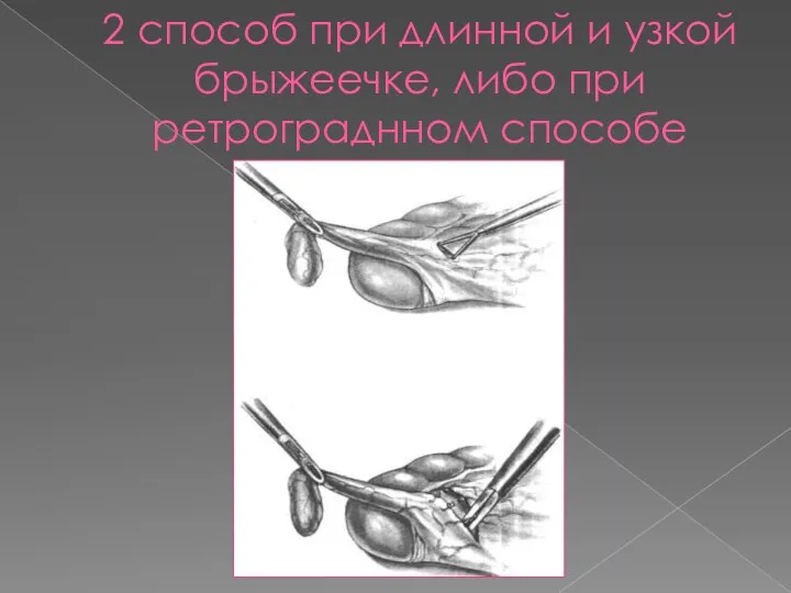 2 способ при длинной и узкой брыжеечке, либо при ретрограднном способе