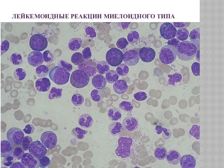 ЛЕЙКЕМОИДНЫЕ РЕАКЦИИ МИЕЛОИДНОГО ТИПА