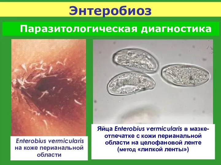 Яйца Enterobius vermicularis в мазке- отпечатке с кожи перианальной области на