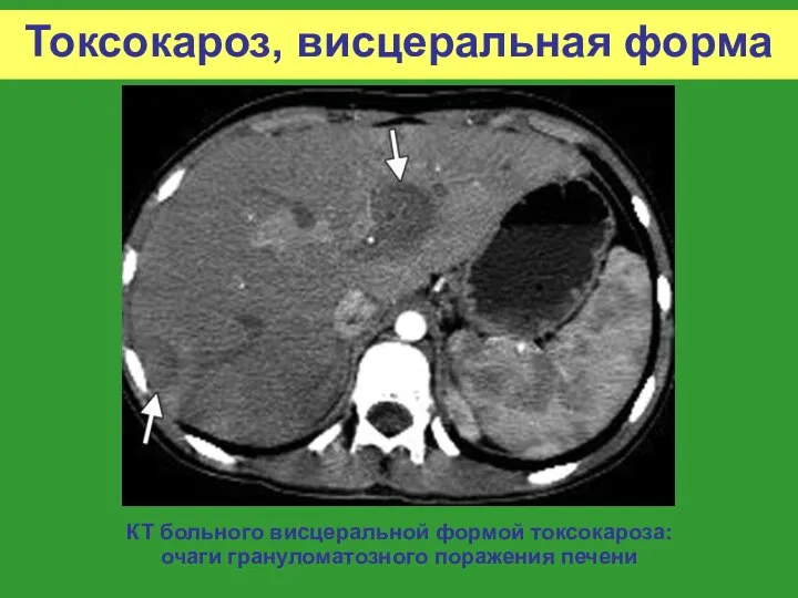 Токсокароз, висцеральная форма КТ больного висцеральной формой токсокароза: очаги грануломатозного поражения печени