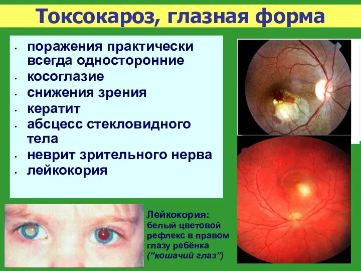 Токсокароз, глазная форма поражения практически всегда односторонние косоглазие снижения зрения кератит