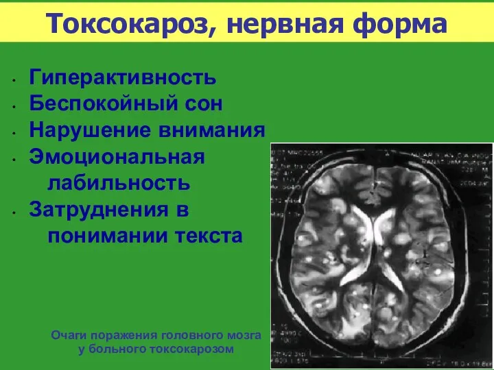 Токсокароз, нервная форма Гиперактивность Беспокойный сон Нарушение внимания Эмоциональная лабильность Затруднения