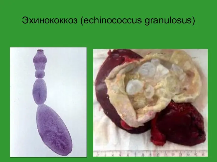 Эхинококкоз (echinococcus granulosus)
